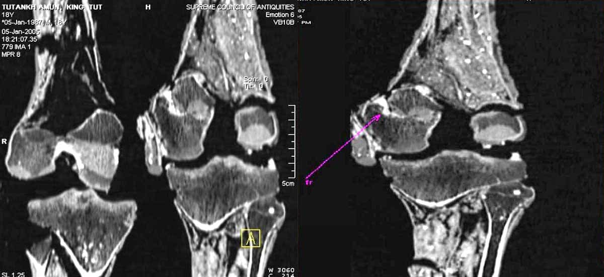 tut fracture