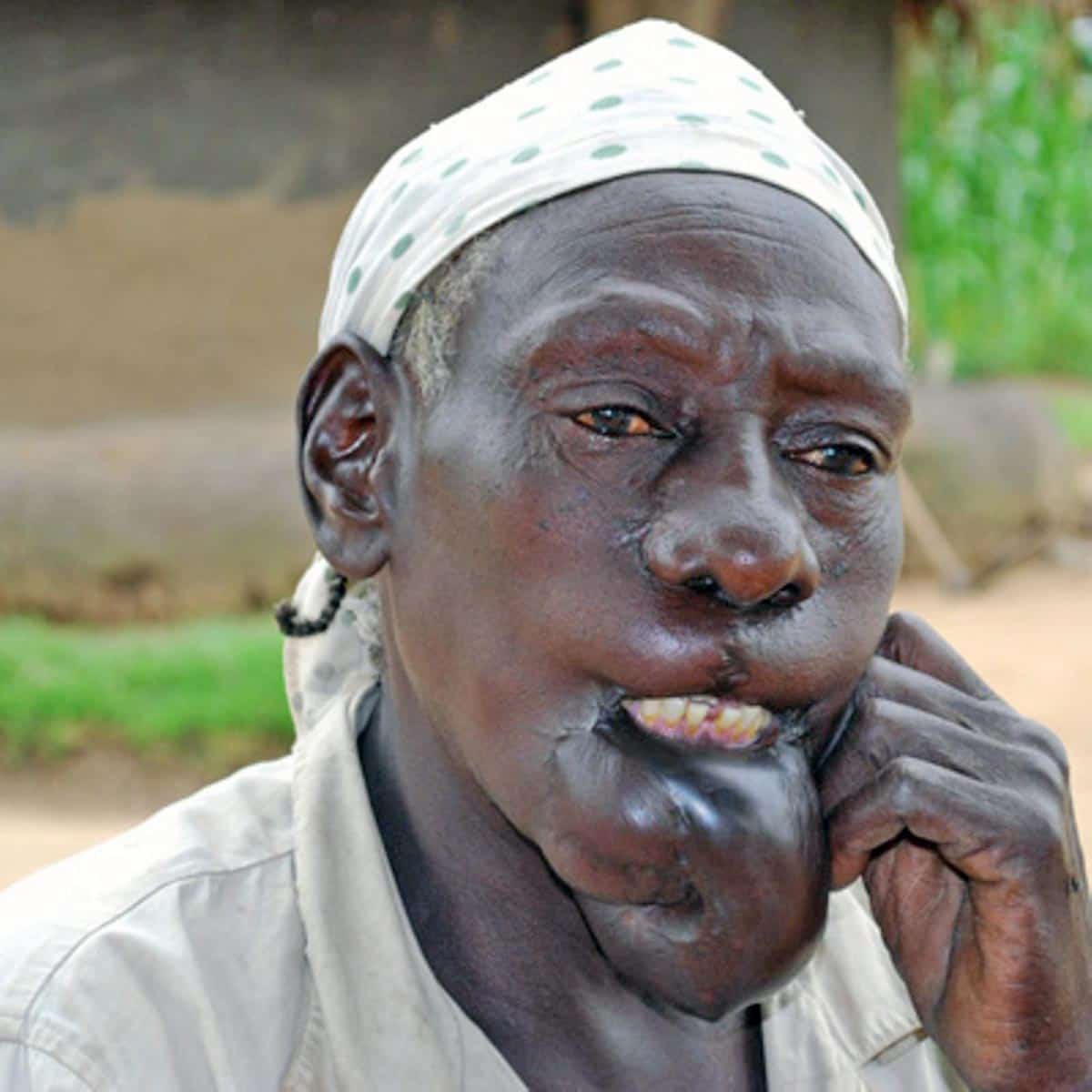 lra mutilation victim