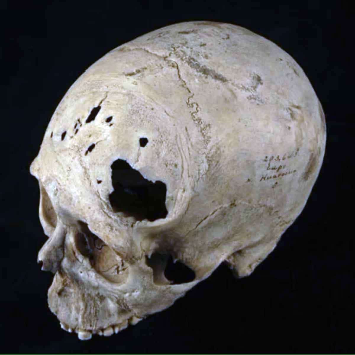 inca skull trepanned brain surgery